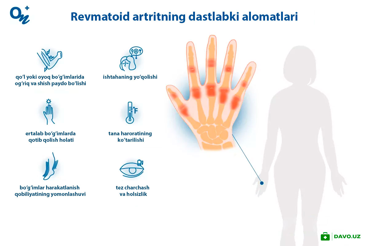 Revmatoid--alomatlari